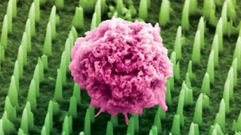 របកគំហើញក្នុងការធ្វើរោគវិនិច្ឆ័យមហារីក៖ បំណះខ្នាតតូចជំនួសការធ្វើកោសល្យវិច័យ