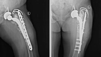 Lần đầu ở miền Trung - Tây Nguyên thay khớp háng và xương đùi bằng Megaprosthesis