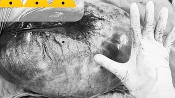 Khối u nặng tới 8kg trong buồng trứng bé gái 13 tuổi