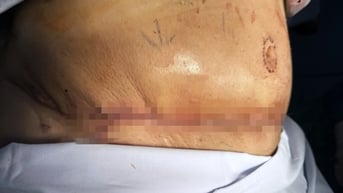 Tốn trăm triệu, đánh đổi tính mạng đi hút mỡ, thực hiện "combo" làm đẹp