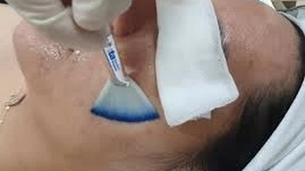 Peel da có giúp làm giảm tình trạng da sẫm màu, da thâm?