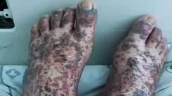 Căn bệnh hiếm khiến cô gái 17 ở TPHCM tuổi bỗng xuất huyết toàn thân