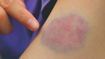 Bỗng dưng xuất hiện vết bầm tím, có thể là dấu hiệu rối loạn tiểu cầu