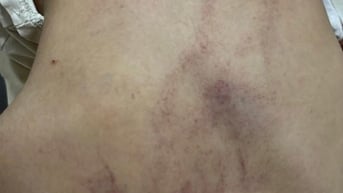 Đình chỉ thêm một giáo viên vụ bạo hành bé gái 4 tuổi