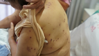 Cứu người phụ nữ bị ong vò vẽ đốt 70 vết, gây sốc phản vệ