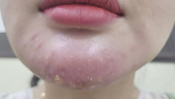 Tiêm filler không rõ nguồn gốc, một phụ nữ bị biến chứng nguy hiểm