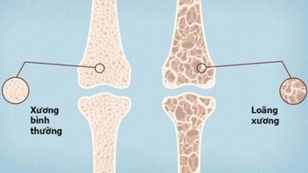 យុវជន​មាន​ជំងឺ​ពុក​ឆ្អឹង​មុន​អាយុ​ដោយសារ​របប​អាហារ​មិន​ល្អ និង​ខ្វះ​ការ​ហាត់ប្រាណ​។