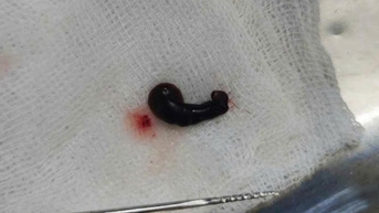 두통, 코피가 며칠째 계속 나서 병원에 가보니 코에 거머리가 있다는 사실을 알게 됐어요.