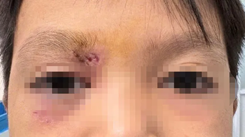 Mảnh gỗ 1,5cm khiến bé trai suýt mù loà