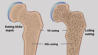 Làm gì để phòng ngừa bệnh loãng xương?