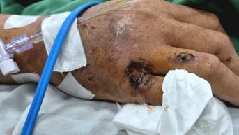 Cháy xém, ngưng tim do điện giật