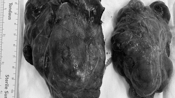 Cụ bà bị khối bướu cổ to chèn ép gây khó thở