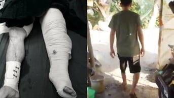 Kỳ diệu: 1 năm sau khi bị tai nạn đứt lìa chân, nam công nhân đã đi được