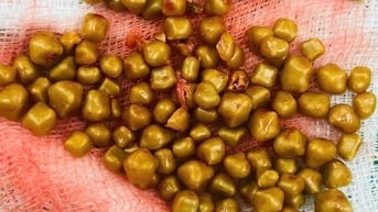 Hy hữu nữ bệnh nhân có hơn 100 viên sỏi trong túi mật
