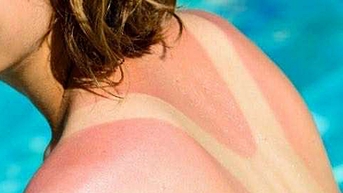 Gia tăng ung thư da vì phơi nắng quá mức