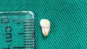 Trẻ sơ sinh có răng mọc ngay lúc sinh, hiện tượng hiếm gặp hay kỳ lạ?