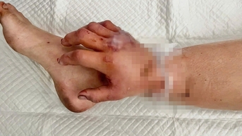 왜 의사는 쌍둥이를 임신한 소녀의 다리에 잘린 손을 일시적으로 이식해야 했을까?