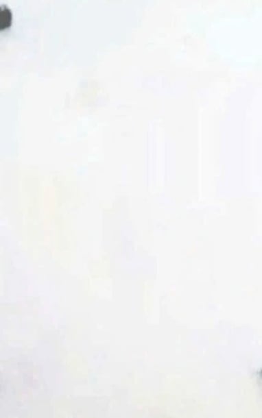 소년, 자석 4개 삼켜 장 천공 발생