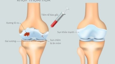 Tăng nặng cơn đau thoái hoá khớp do thừa cân, béo phì