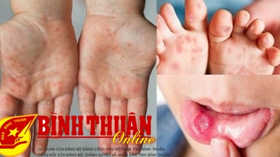 1 ca tử vong nghi do bệnh tay chân miệng