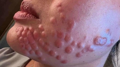 Rước vạ vì ham làm đẹp cấp tốc đón Tết