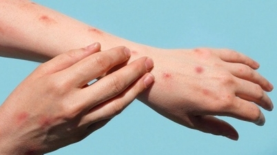 How does Vietnam respond to monkeypox?