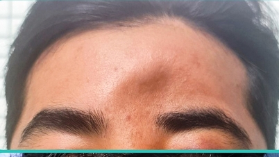 Reconstructing a normal face for a patient with frontal bone depression