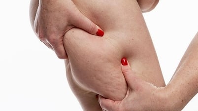 Mắc bệnh hiếm, cô gái phải hút 6,5 lít mỡ từ chân