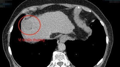 Cụ bà đi khám sức khỏe, bác sĩ phát hiện khối u gan 3 cm