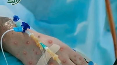 Monkeypox បានចូលទៅក្នុងសហគមន៍ហើយអាចលេចឡើងគ្រប់ទីកន្លែង។