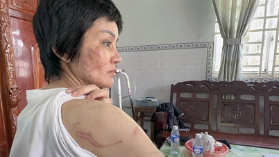 205 vết thương trên người vợ bầu 7 tháng, là tra tấn chứ không phải bạo lực 