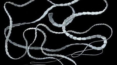 Phát hiện sán dài 6m trong cơ thể của một cô gái