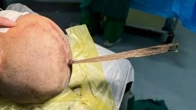 Boy stabbed in the skull while playing