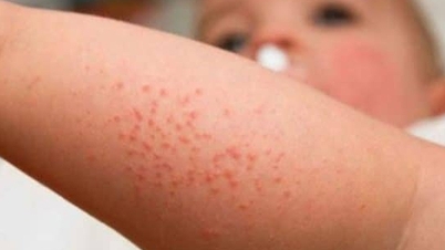 Bệnh sởi có dấu hiệu gia tăng dịp Tết, chăm sóc trẻ bệnh sởi tại nhà như thế nào?