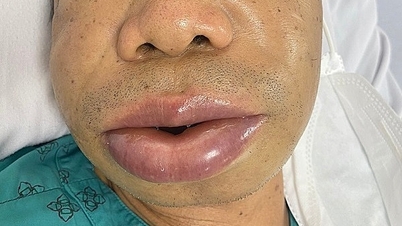 angioedema តំណពូជ