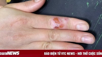 Granuloma ពីចំណង់ចំណូលចិត្តអាងចិញ្ចឹមត្រី