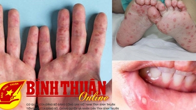 Bệnh tay chân miệng biến chứng nặng do vi rút EV71