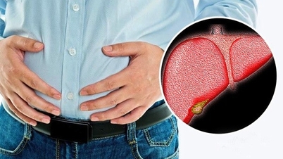 3 triệu chứng cảnh báo gan nhiễm mỡ ở phụ nữ