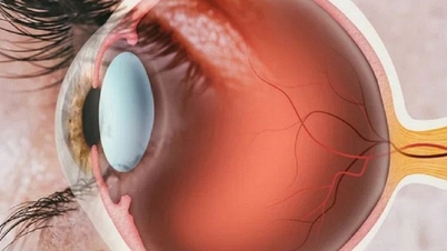 What should patients prepare before cataract surgery?