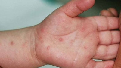Đã có nguồn cung thuốc điều trị bệnh tay chân miệng về Việt Nam