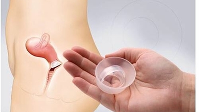 Bạn biết gì về các phương pháp tránh thai?
