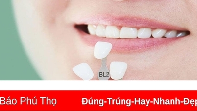Dán sứ Veneer an toàn với chi phí hợp lý tại Nha Khoa Shark