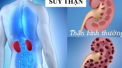 Đi khám vì đau đầu, người đàn ông ở Hà Nội mới biết mình bị suy thận giai đoạn cuối