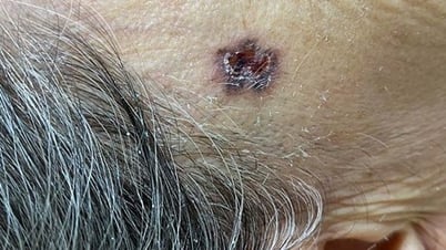 Hàng trăm bệnh nhân bị ung thư da do đi nắng không che chắn
