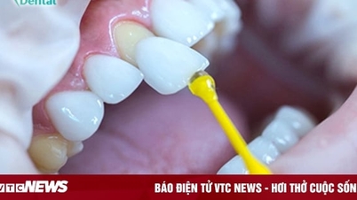 Xsmile technology - a new breakthrough in porcelain crowns without grinding at Thien Ha