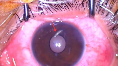 While repairing his car, a young man was stabbed in the eye by a piece of metal.