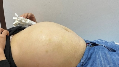 Bệnh viện Phụ sản Hà Nội phẫu thuật thành công u nhầy buồng trứng nặng 8 kg