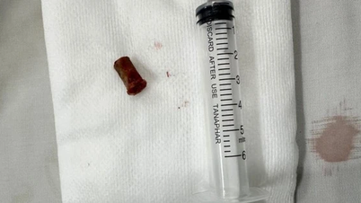 A trumpet in a boy's lung for 7 years, many hospitals failed to detect it
