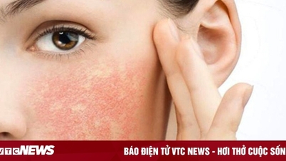 Các dấu hiệu dị ứng mỹ phẩm mà bạn nên biết