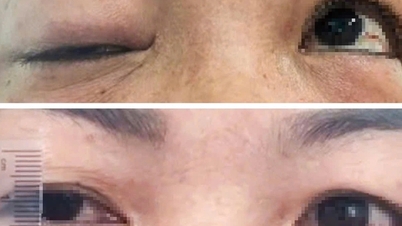 Combining traditional and modern medicine to treat a woman's ptosis